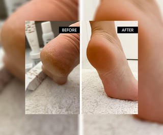 Refeet softening foot cream with urea and shea butter