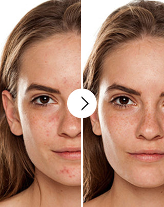 Derminax tablets with zinc and vitamins C, E and B2 for acne, blemishes and imperfections - 2