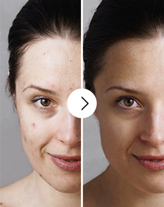 Derminax tablets with zinc and vitamins C, E and B2 for acne, blemishes and imperfections